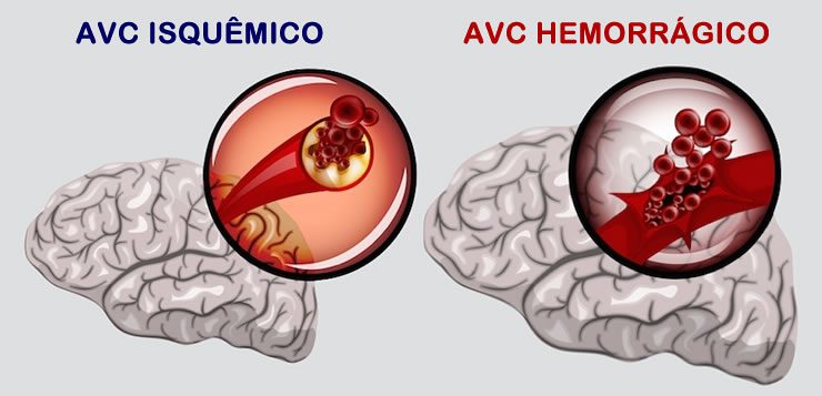 Foto: AVC: Aprenda a identificar e se prevenir