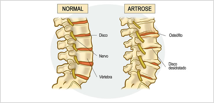 tratamento para artrose