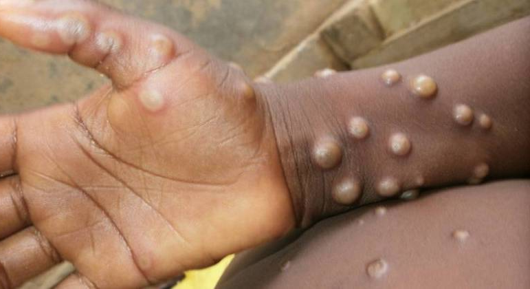 Confira alguns mitos e verdades sobre a varíola do macaco